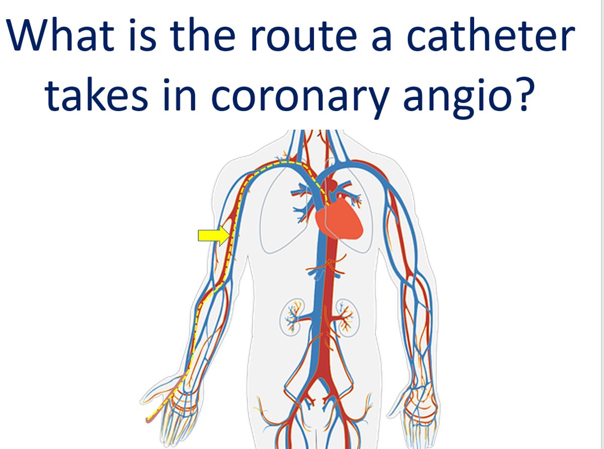 What Is The Route A Catheter Takes In Coronary Angio All About Heart