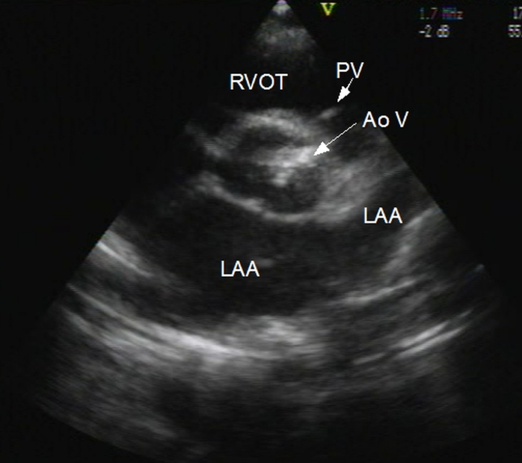 Aortic Stenosis Echocardiogram In Parasternal Short Axis View