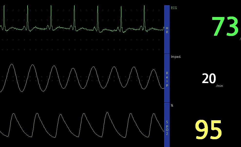 Ecg Respiration And Spo Tracings