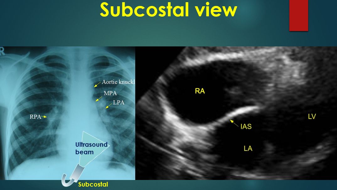 Basic Echocardiographic Views All About Cardiovascular System And