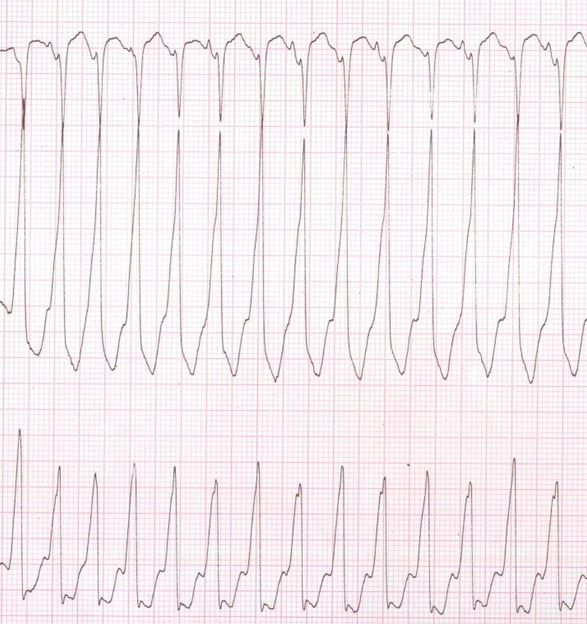 Ventricular Tachycardia ECG