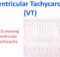 Ventricular Tachycardia (VT)