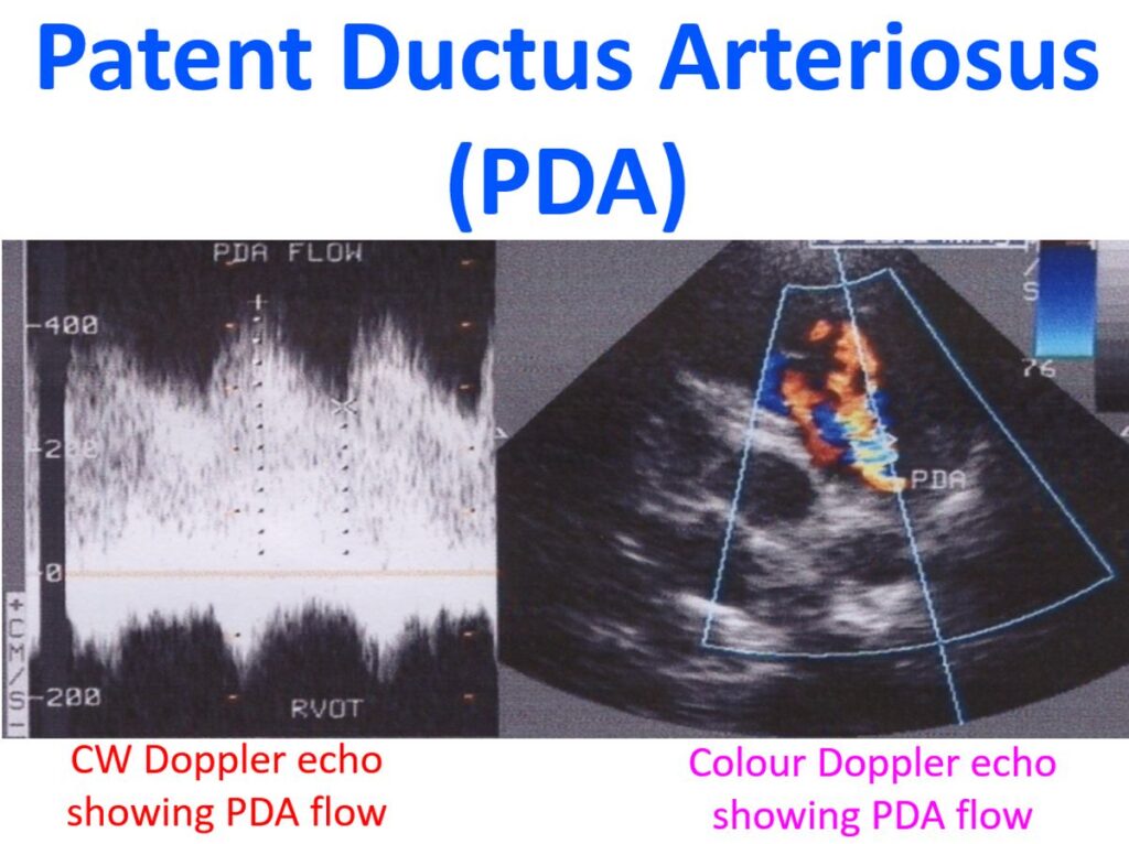 patent ductus arteriosus echo