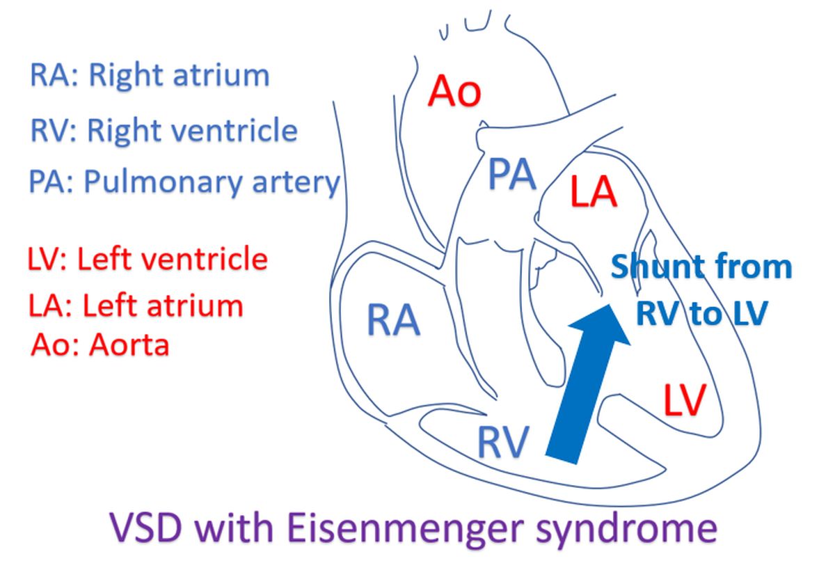 VSD with Eisenmenger Syndrome