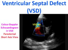 Ventricular Septal Defect (VSD)