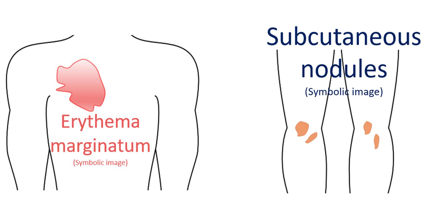 Erythema Marginatum and Subcutaneous Nodules