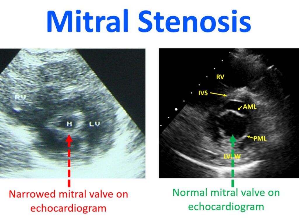 Mitral Stenosis All About Heart And Blood Vessels