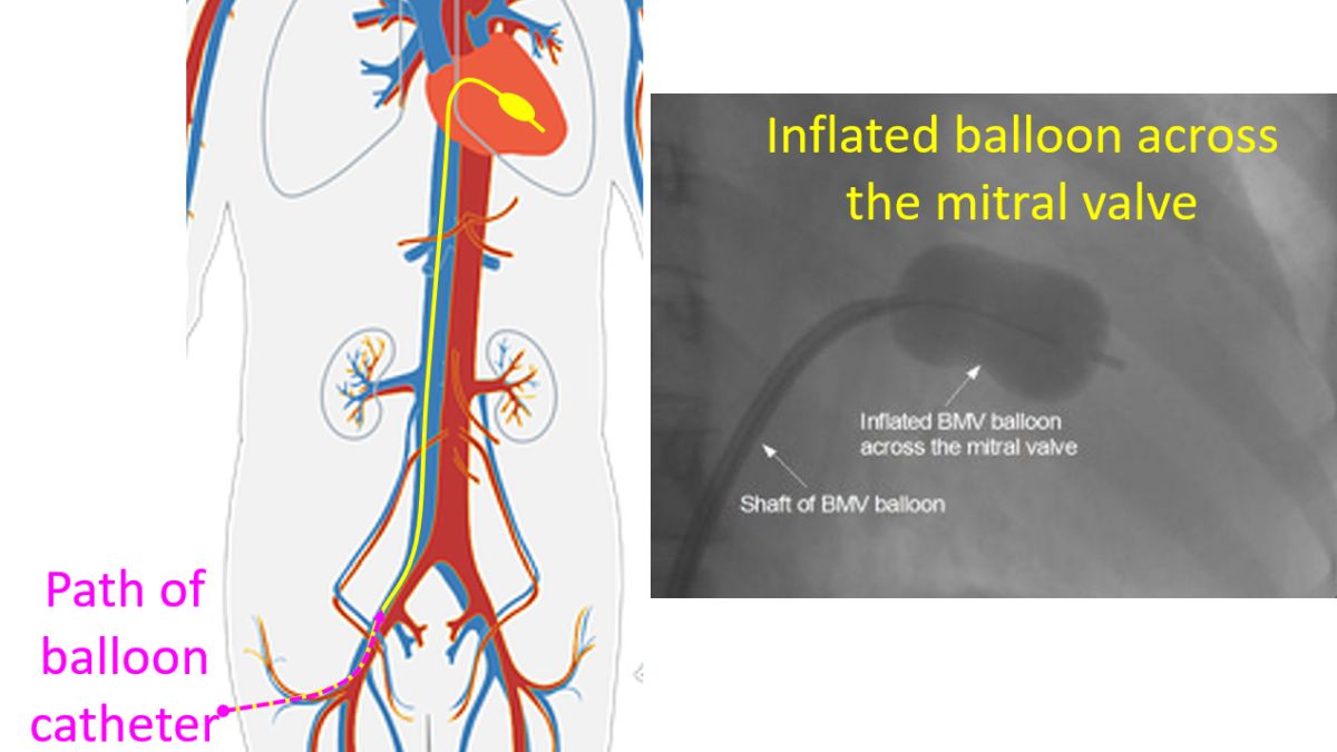 Path of balloon catheter from the groin