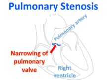 Pulmonary Stenosis