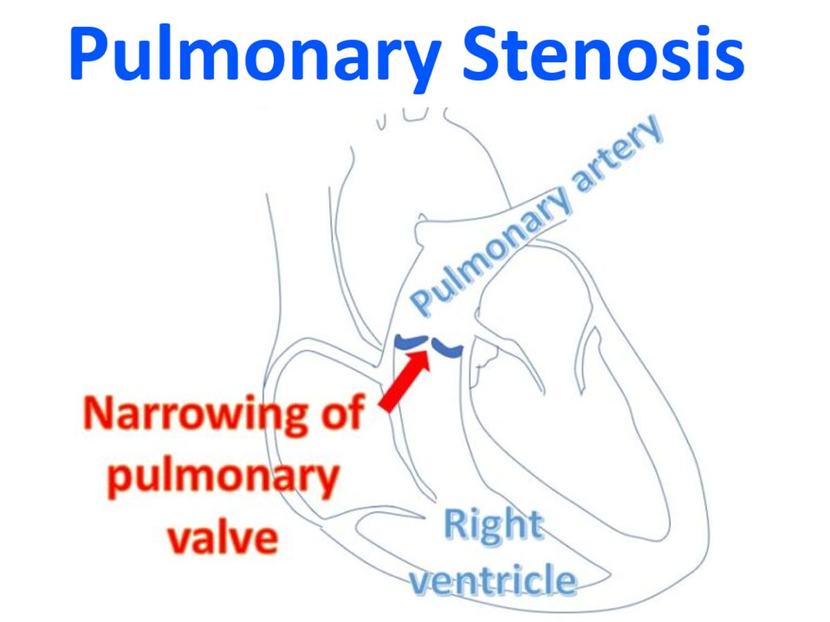 Pulmonary Stenosis – All About Heart And Blood Vessels