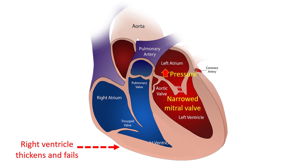 Right ventricle thickens and fails