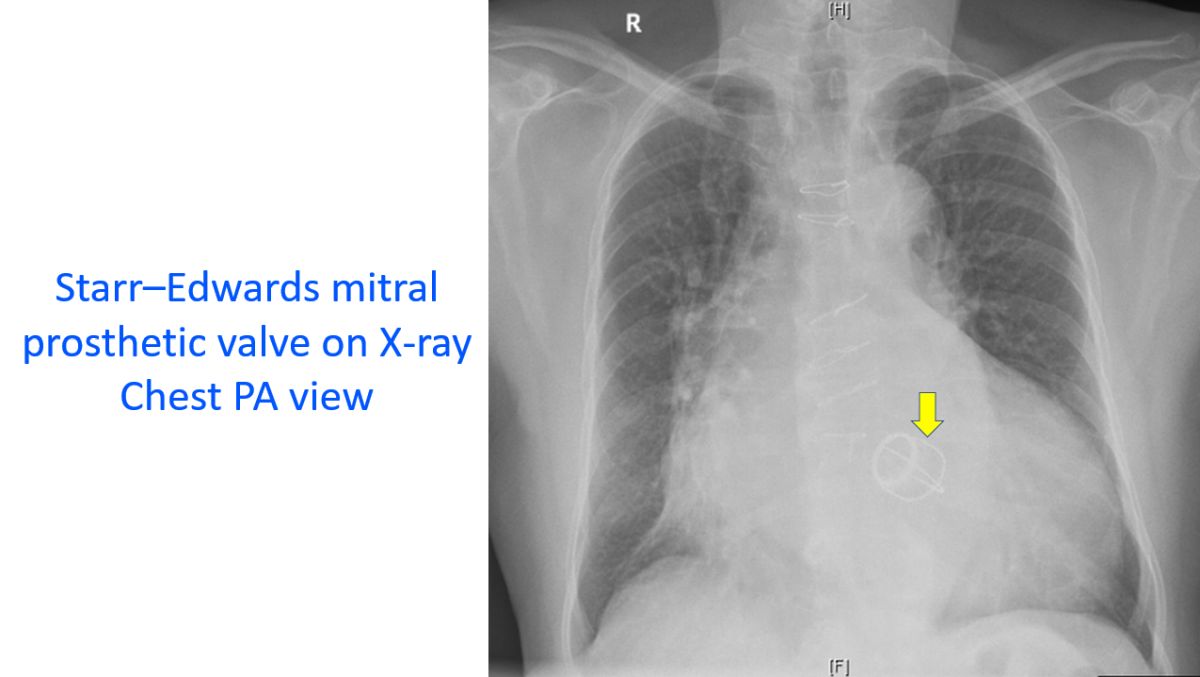 Starr–Edwards mitral prosthetic valve on X-ray Chest PA view