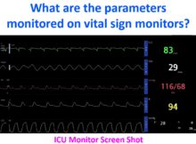 What are the parameters monitored on vital sign monitors