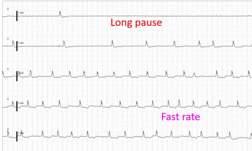 What Is Sick Sinus Syndrome? – All About Heart And Blood Vessels