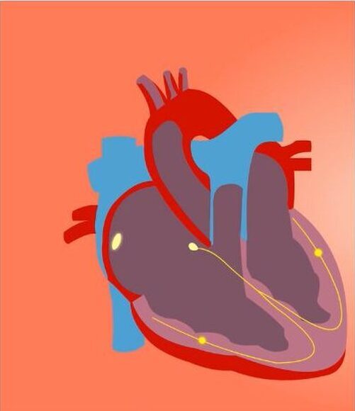 What is an Electrical Defect of the Heart