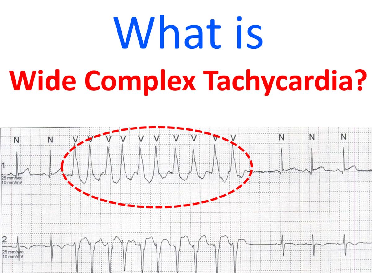 wide qrs complex tachycardia