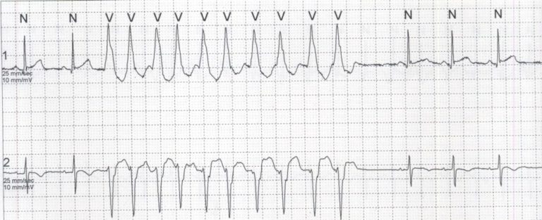 Wide complex tachycardia – All About Heart And Blood Vessels