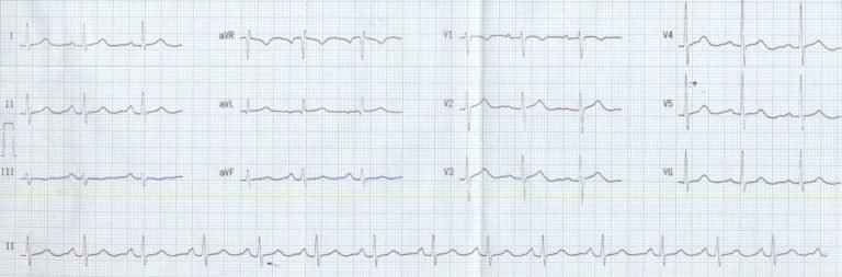 PQRST in ECG – All About Heart And Blood Vessels