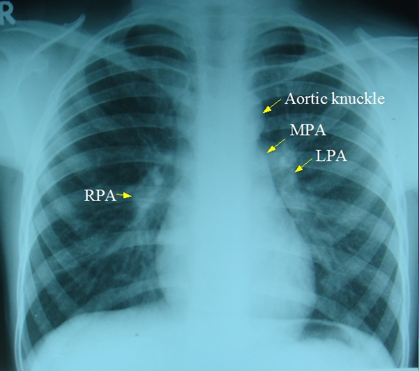 Normal chest X-ray