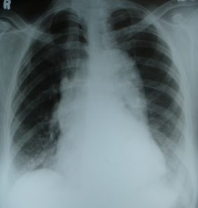 rotated-film-with-prominent-aorta