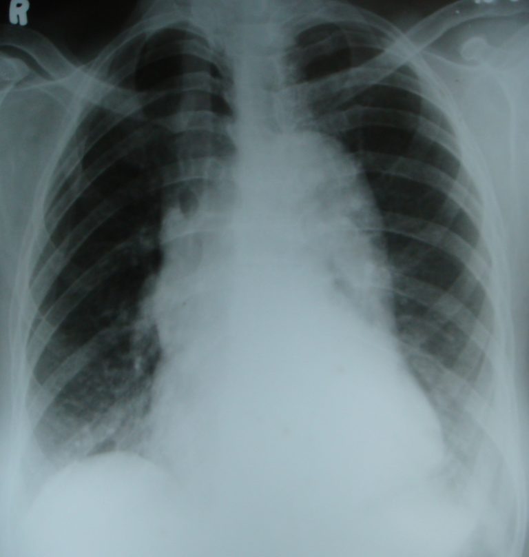 Rotated Chest X-ray – All About Heart And Blood Vessels