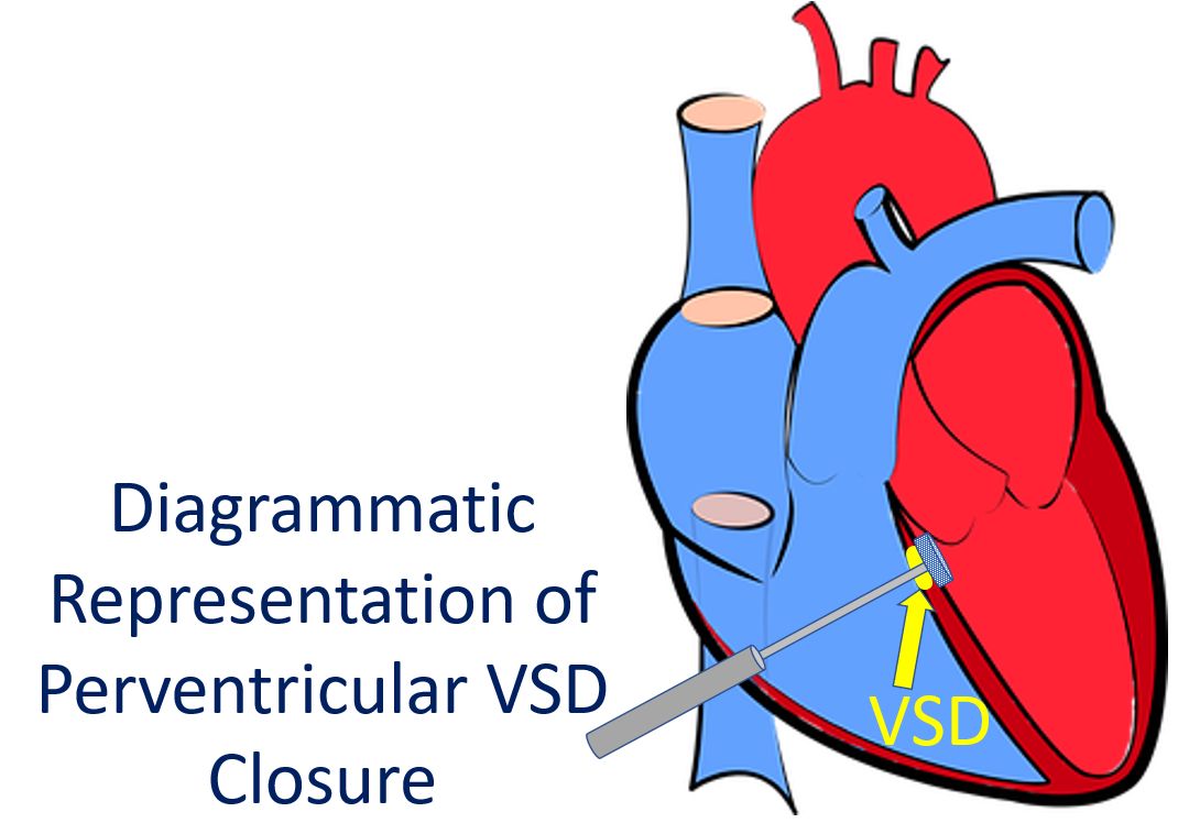 Diagrammatic Representation of Perventricular VSD Closure1