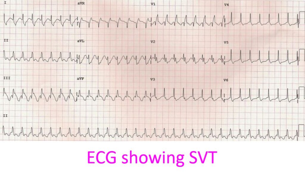 ECG showing SVT