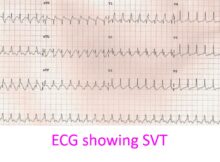 ECG showing SVT