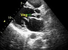 Vegeation on aortic valve