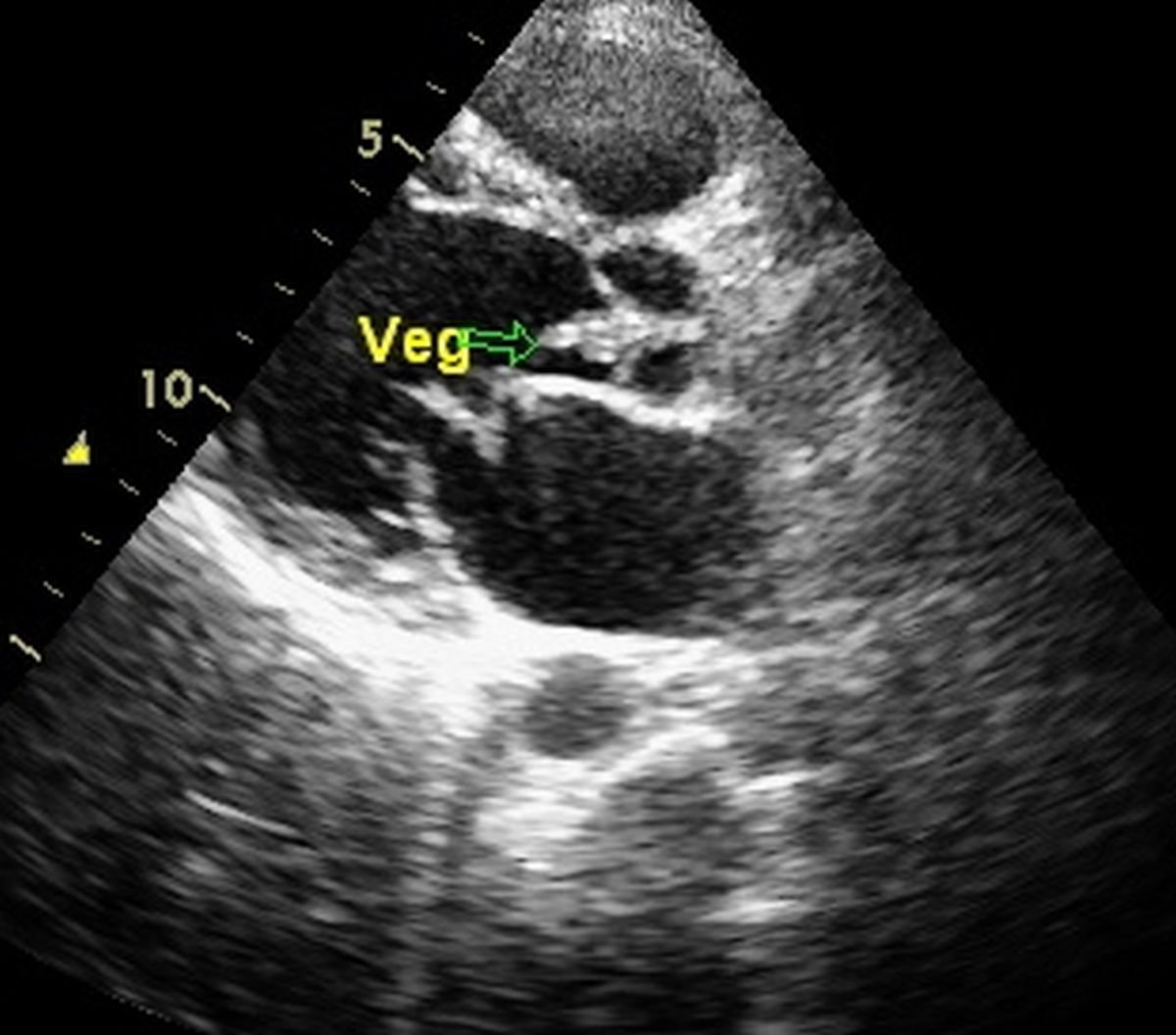 Vegeation on aortic valve