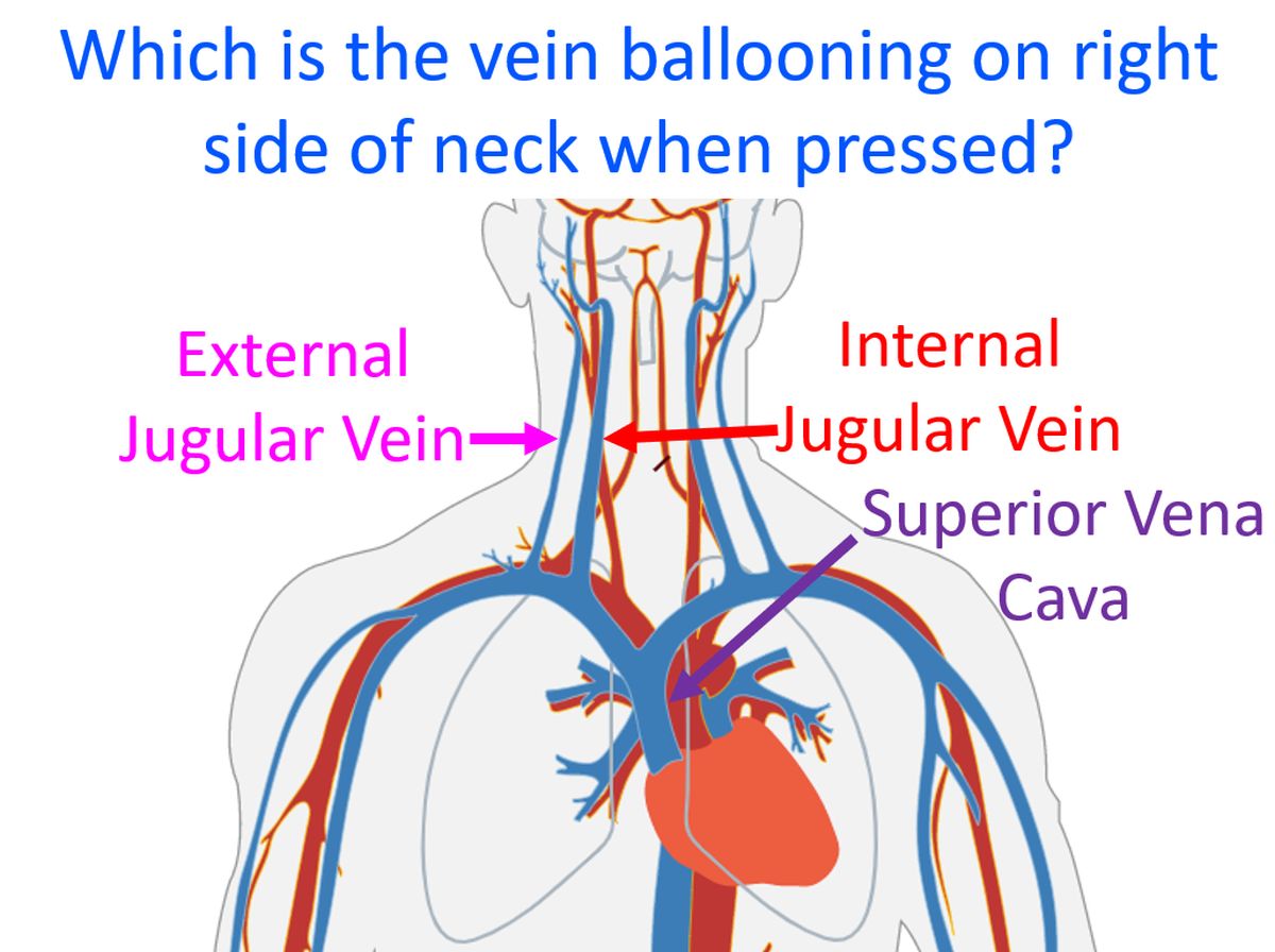 Which is the vein ballooning on right side of neck when pressed