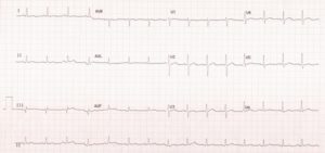 12 Lead ECG - All About Heart And Blood Vessels