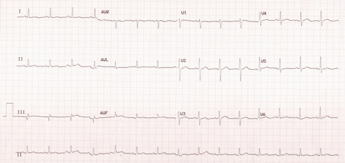 12 lead ECG