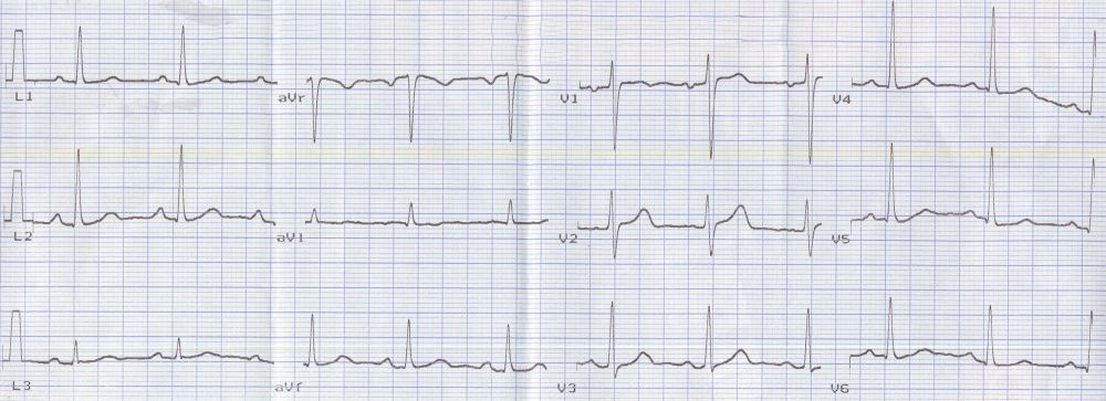 Electrocardiogram (ECG)