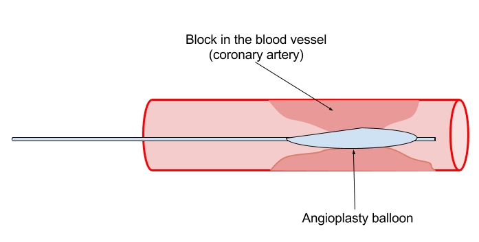 Balloon Angioplasty