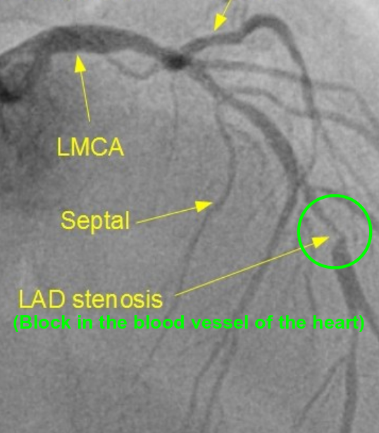 Block in blood vessel of the heart