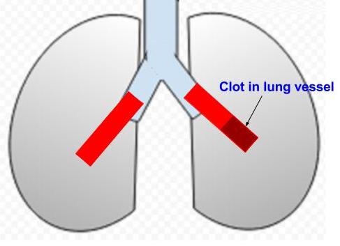 Clot in lung vessel