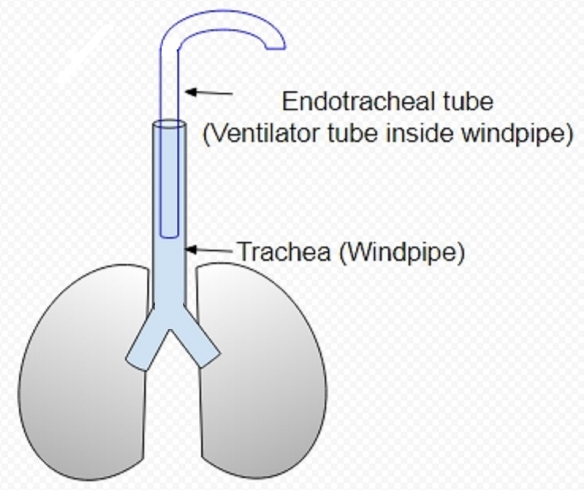 Non invasive ventilation