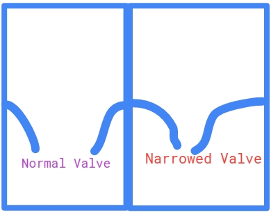 Narrowed heart valve