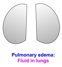 pulmonary edema