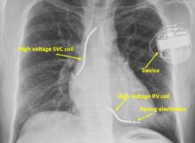 X-ray of a person with ICD