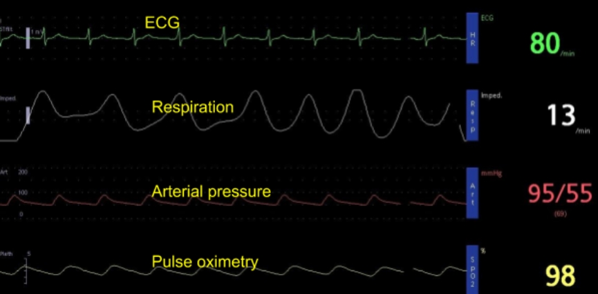 ICU Monitor