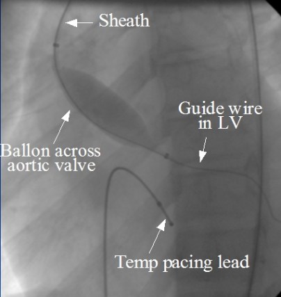 Inflated balloon across aortic valve
