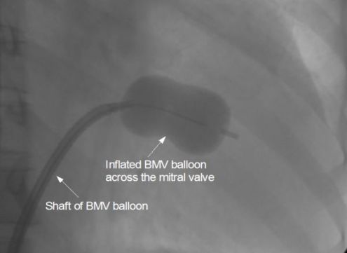 Inflated balloon across mitral valve