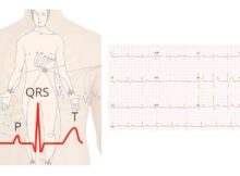 What is an ECG?