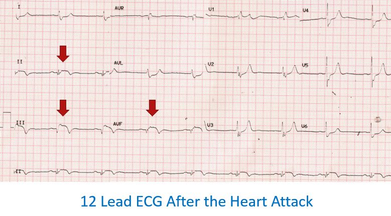 12 lead ECG after a heart attack
