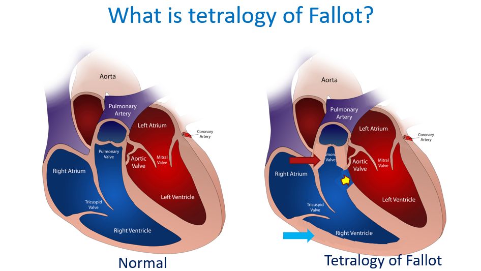 Comparison of normal and Tetralogy of Fallot