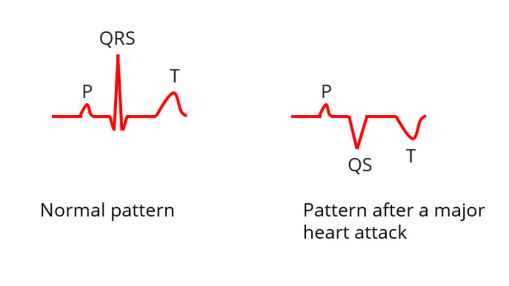 Simplified explanation of ECG changes in a heart attack - All About ...