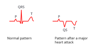 Simplified explanation of ECG changes in a heart attack – All About ...