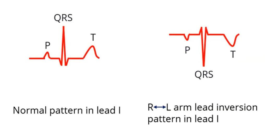ECG in R-L arm lead reversal